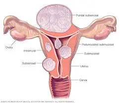 Medical diagram explaining growth of fibroids in the uterus