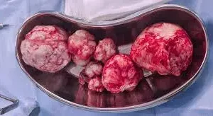 Illustration showing different types of uterine fibroids in women