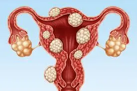 Advanced uterine fibroids care at Fibroids India clinic in Mumbai