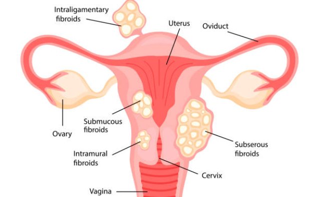 Get expert care for fibroids and fertility in Mumbai